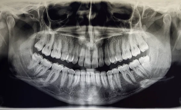 Ortopantomografie dospělého pacienta, zubní lékařství — Stock fotografie