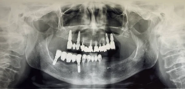 Ortoantomografia de um paciente adulto, odontologia — Fotografia de Stock