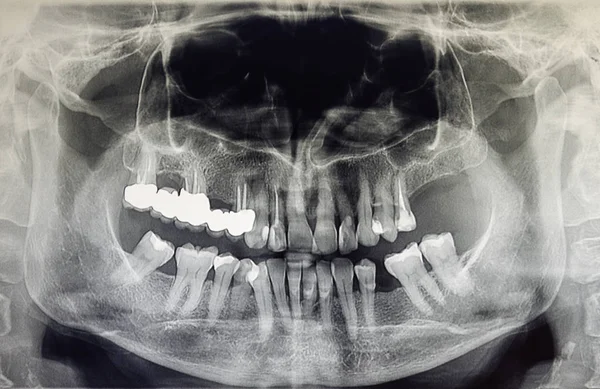 Ortopantomografi av en vuxen patient, tandvård — Stockfoto