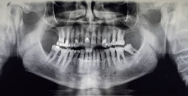 Ortoantomografia de um paciente adulto, odontologia — Fotografia de Stock