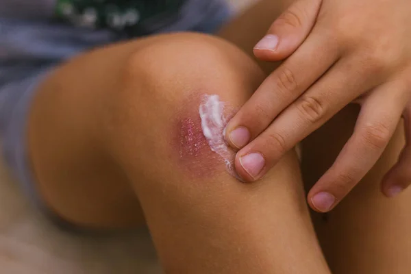 The child smears cream on the damaged skin on the leg. Dry skin and irritation. Allergic reactions. Wound on the knee.