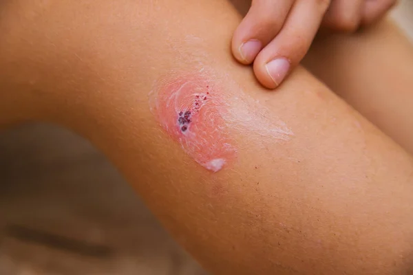 The child smears cream on the damaged skin on the leg. Dry skin and irritation. Allergic reactions. Wound on the knee.