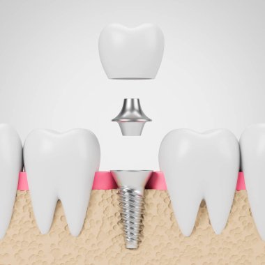 Teeth with implant screw, white background clipart