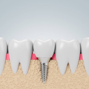 Teeth with implant screw, gray background clipart