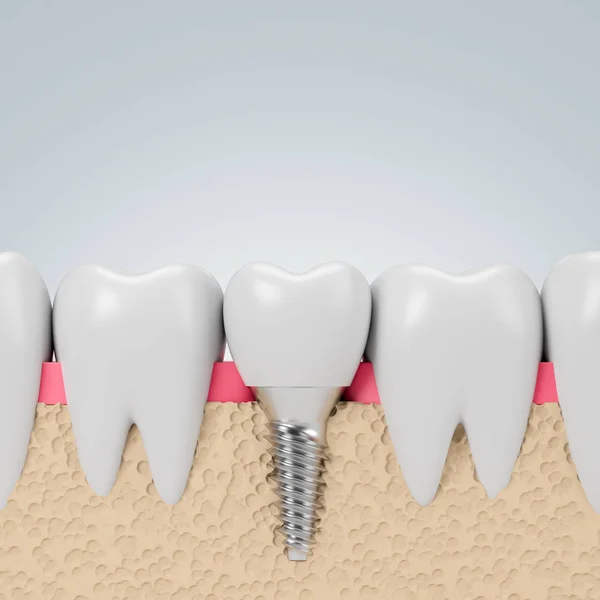 Tanden met implantaat schroef, grijze achtergrond — Stockfoto