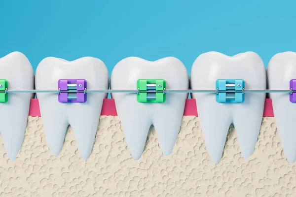 Modelo de dentes brancos com aparelho colorido — Fotografia de Stock