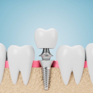 Teeth with implant screw, blue background clipart