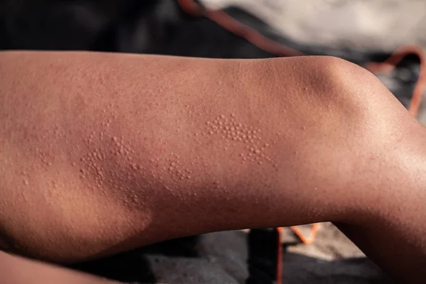 Plaquettes Sur Peau Sur Ses Pieds Par Temps Ensoleillé Cloques — Photo