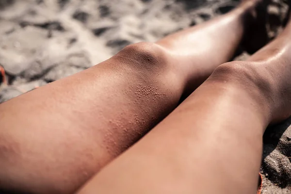 Blisters Skin His Feet Sunny Weather Blisters His Hip — Stock Photo, Image