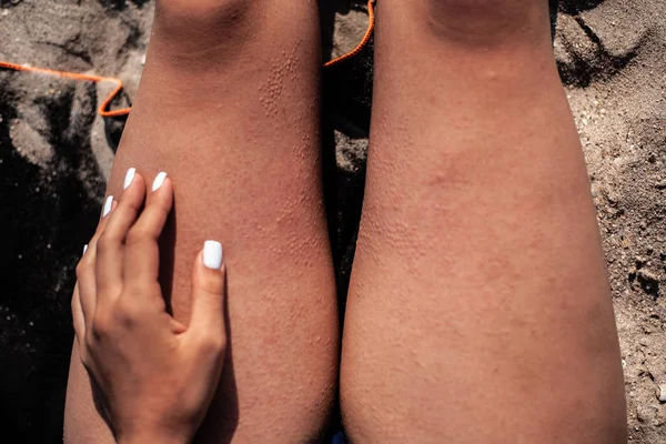 Plaquettes Sur Peau Sur Ses Pieds Par Temps Ensoleillé Cloques — Photo