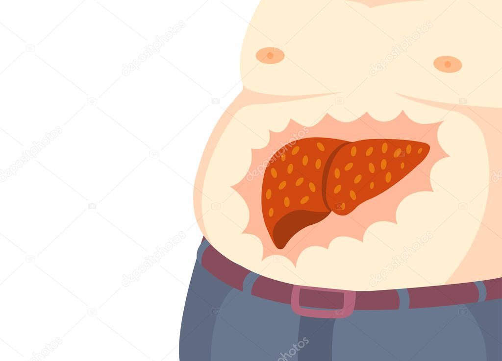 Fatty liver is a group of diseases caused by fat accumulation in the liver.