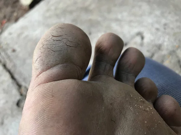 Ραγισμένα Τακούνια Στα Δάχτυλα Των Αριστερών Ποδιών Που Χρειάζεται Φαρμακευτική — Φωτογραφία Αρχείου