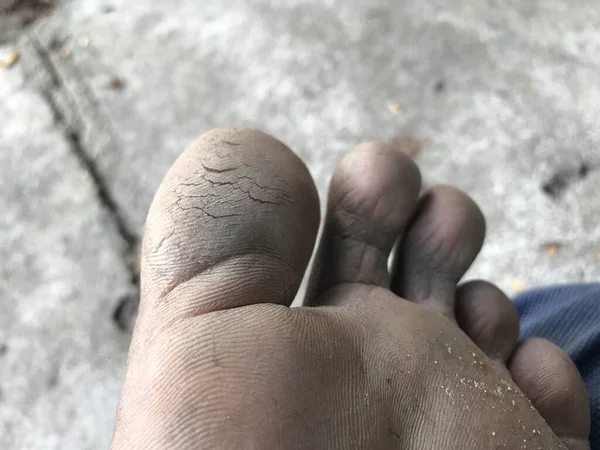Ραγισμένα Τακούνια Στα Δάχτυλα Των Αριστερών Ποδιών Που Χρειάζεται Φαρμακευτική — Φωτογραφία Αρχείου
