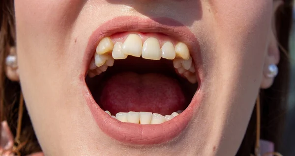 Zakrzywione Żeńskie Zęby Przed Zamontowaniem Aparatu Close Zębów Przed Leczeniem — Zdjęcie stockowe