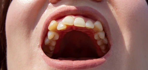 Denti Femminili Curvi Prima Installare Apparecchio Primo Piano Dei Denti — Foto Stock