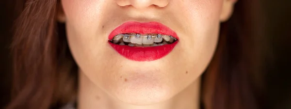 Sistema de brasket em boca sorridente, dentes foto macro, close-up lábios, tiro macro. — Fotografia de Stock
