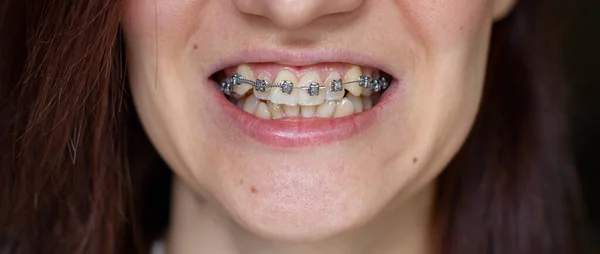 Gülümseyen Ağızda Brasket Sistemi Makro Fotoğraf Dişleri Yakın Plan Dudaklar — Stok fotoğraf