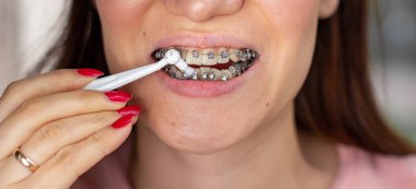 Gülümseyen ağızda brasket sistemi, makro fotoğraf dişleri, yakın plan dudaklar, makro çekim. Parantez sistemi taranıyor