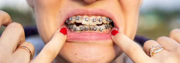 Brasket System Smiling Mouth Macro Photo Teeth Close Lips Macro — Stock Photo, Image