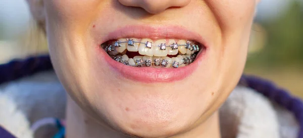 Brasket System Smiling Mouth Macro Photo Teeth Close Lips Macro — Stock Photo, Image