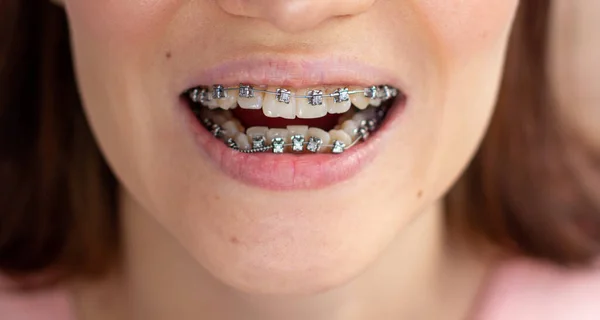 Brasket system in smiling mouth, macro photo teeth, close-up lips, macro shot. — Stock Photo, Image