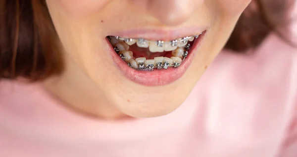 Brasket system in smiling mouth, macro photo teeth, close-up lips, macro shot. — Stock Photo, Image