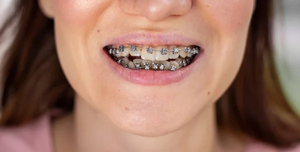 Brasketový systém v usměvavých ústech, makro foto zuby, detailní rty, makro snímek. — Stock fotografie
