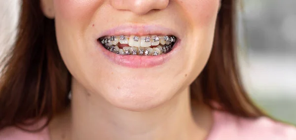 Brasket system in smiling mouth, macro photo teeth, close-up lips, macro shot. — Stock Photo, Image