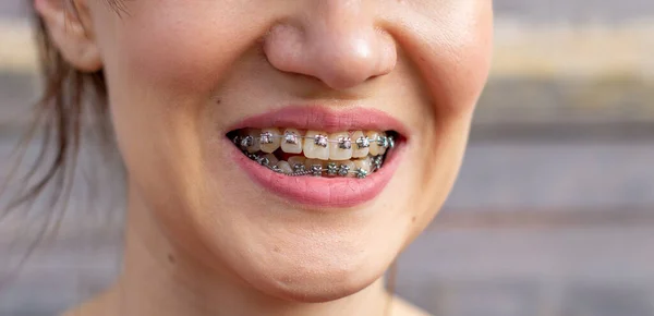 System Brasket Uśmiechniętych Ustach Makro Zdjęcia Zębów Zbliżenie Ust Ujęcie — Zdjęcie stockowe