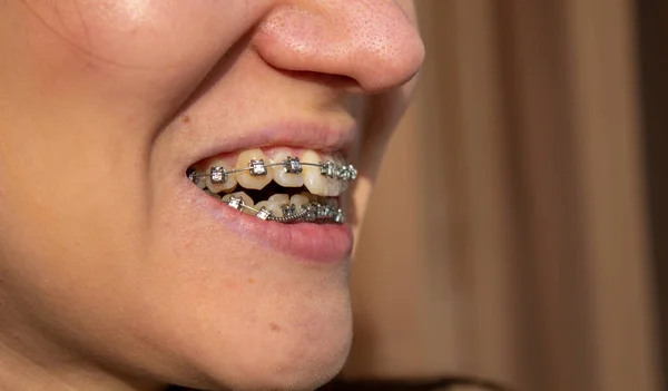 Brasket system in smiling mouth, macro photo teeth, close-up lips, macro shot. — Stock Photo, Image