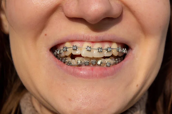 System Brasket Uśmiechniętych Ustach Makro Zdjęcia Zębów Zbliżenie Ust Ujęcie — Zdjęcie stockowe