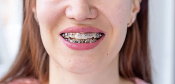 女の子の笑顔の口の中のブラスケットシステム 歯のマクロ写真 唇のクローズアップ — ストック写真
