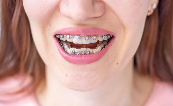 System Brasket Uśmiechniętych Ustach Dziewczyny Makrofotografia Zębów Zbliżenie Ust — Zdjęcie stockowe