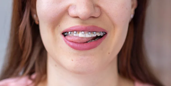 女の子の笑顔の口の中でブレースシステム 歯のマクロ写真 唇のクローズアップ 彼女は舌を出した — ストック写真