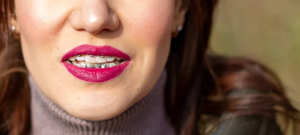 System Ortezy Uśmiechniętych Ustach Dziewczyny Makrofotografia Zębów Zbliżenie Czerwonych Ust — Zdjęcie stockowe
