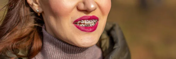 The brace system in the girl\'s smiling mouth, macro photography of teeth, close-up of red lips. Girl walking on the street