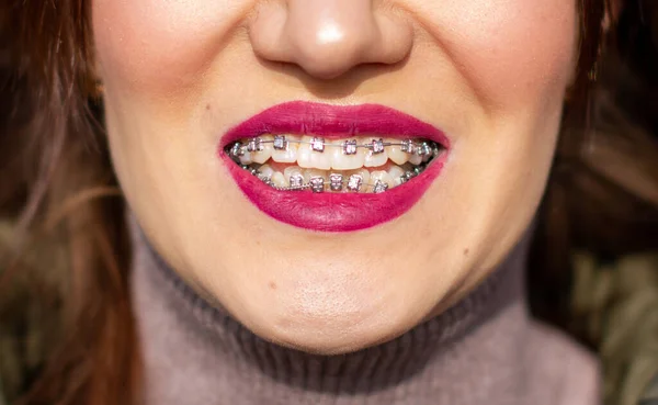 System Ortezy Uśmiechniętych Ustach Dziewczyny Makrofotografia Zębów Zbliżenie Czerwonych Ust — Zdjęcie stockowe