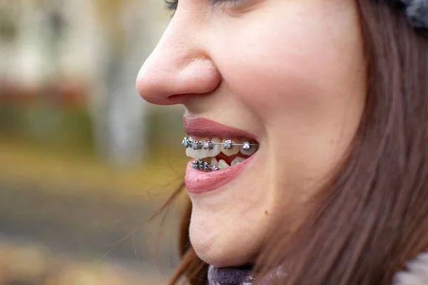 Brasketový Systém Dívčích Usměvavých Ústech Makro Fotografie Zubů Detailní Záběr — Stock fotografie
