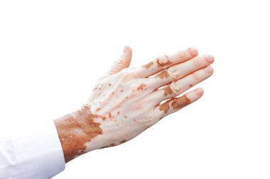 Male hand with vitiligo isolated on white background clipart