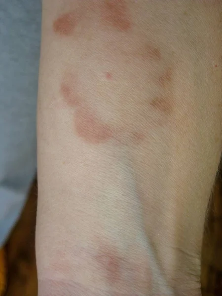 Close up of tick bite on the arm of a woman, close-up. Allergy to insect bites. Wound and consequences after a bite. Encephalitis Virus or Lyme Borreliosis Disease Infectious Dermacentor Tick Arachnid Parasitic Insect.