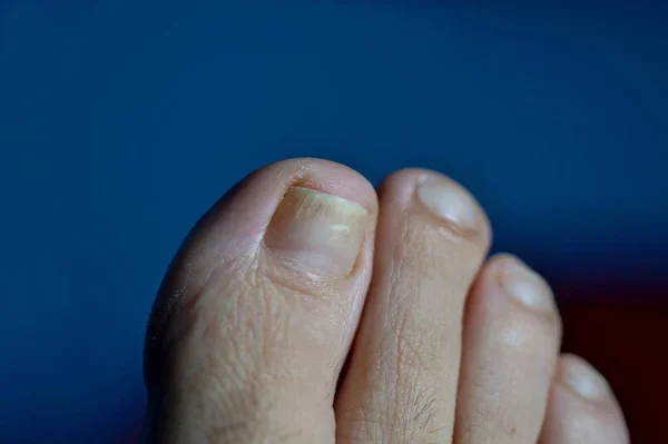 foot with nail psoriasis. A woman has an ingrown toenail. short cutted nails. Dermatitis.