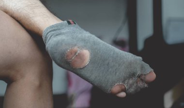 Eski, kirli ve yırtık çoraplar giyen bacak resmi..