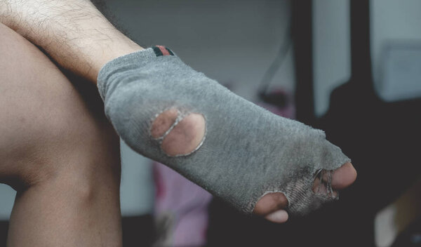 picture of leg wearing old, dirty, and torn socks.