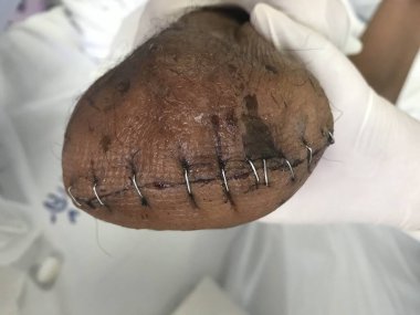 Kütük yarası, bu bir ampütasyon yarası ya da bacaktaki güdük yarası. Sağlık Kavramı.