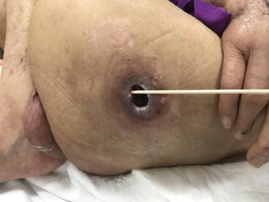 Zayıf kenar ülseri. Sağlık ve Tıp Kavramı.