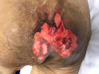 Sahnesiz basınç yaralanması. Sağlık ve Tıp Kavramı.