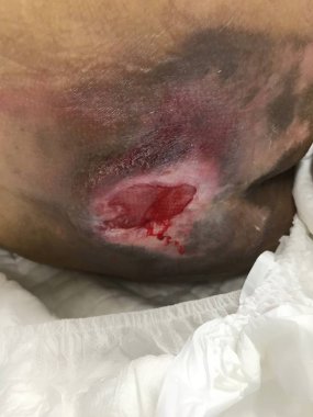 Basınç yaralanması evreiii. Bedsore basınç boğaz yatalak. Sağlık ve Tıp Kavramı.