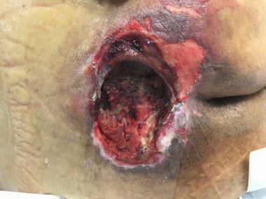 Basınç yaralanması stageiv. Bedsore basınç boğaz yatalak. Sağlık ve Tıp Kavramı.