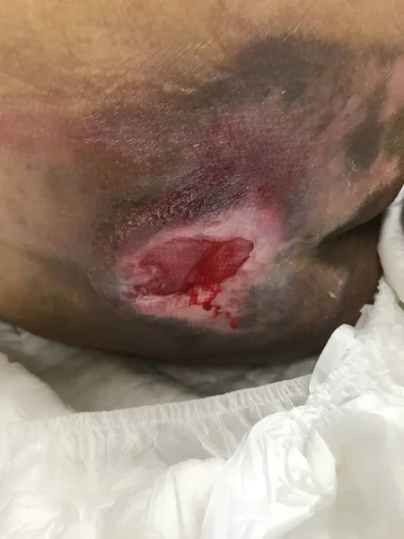 Basınç yaralanması evreiii. Bedsore basınç boğaz yatalak. Sağlık ve Tıp Kavramı.