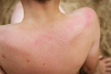 Güneş yanığından sonra cilt hasarı. Çocuk geri döndü..